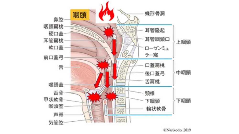 急性扁桃炎の症状や早く治す方法を解説｜急性咽頭炎との違いは？