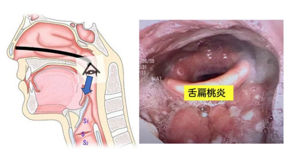 急性扁桃炎の症状や早く治す方法を解説｜急性咽頭炎との違いは？