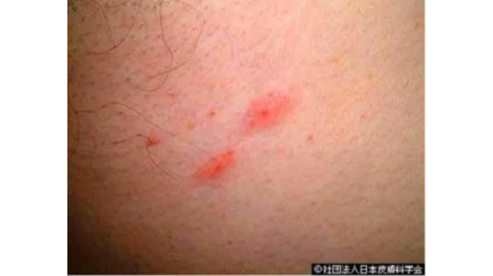 ダニ刺されで悩んでいる方へ!あせもとの違いについて解説!症状や治療についても
