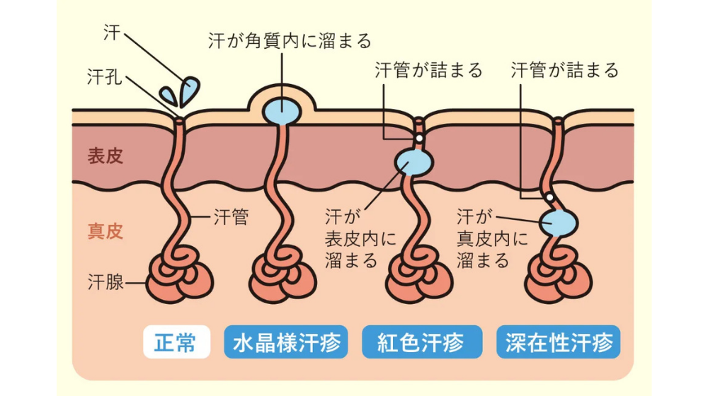 子どもが汗疹(あせも)になったときはどうすればいい？治し方や湿疹との違い・対策法について