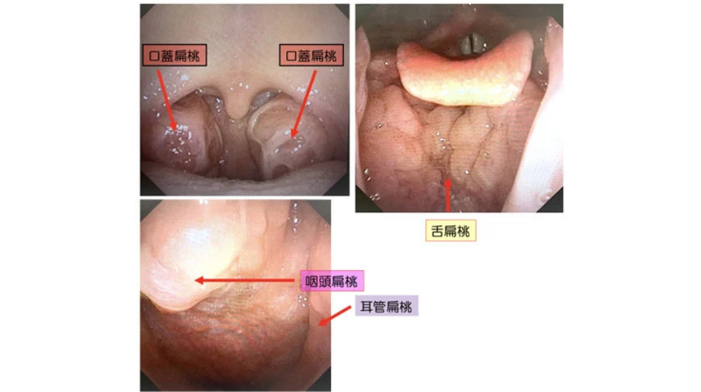 急性扁桃炎の症状や早く治す方法を解説｜急性咽頭炎との違いは？