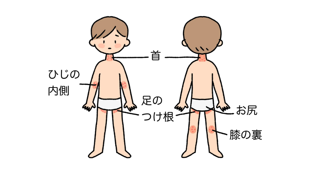 子どもが汗疹(あせも)になったときはどうすればいい？治し方や湿疹との違い・対策法について
