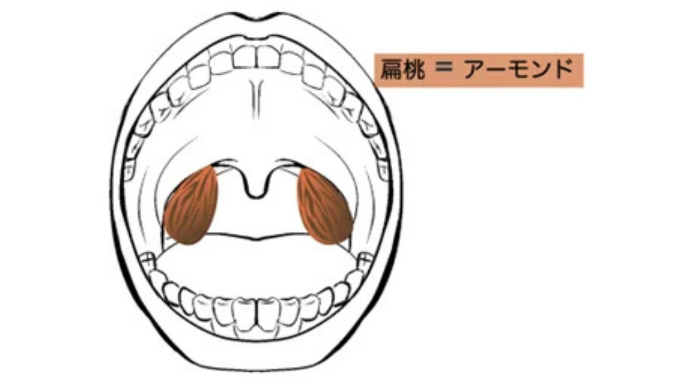 急性扁桃炎の症状や早く治す方法を解説｜急性咽頭炎との違いは？