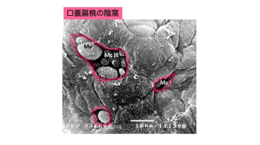 急性扁桃炎の症状や早く治す方法を解説｜急性咽頭炎との違いは？