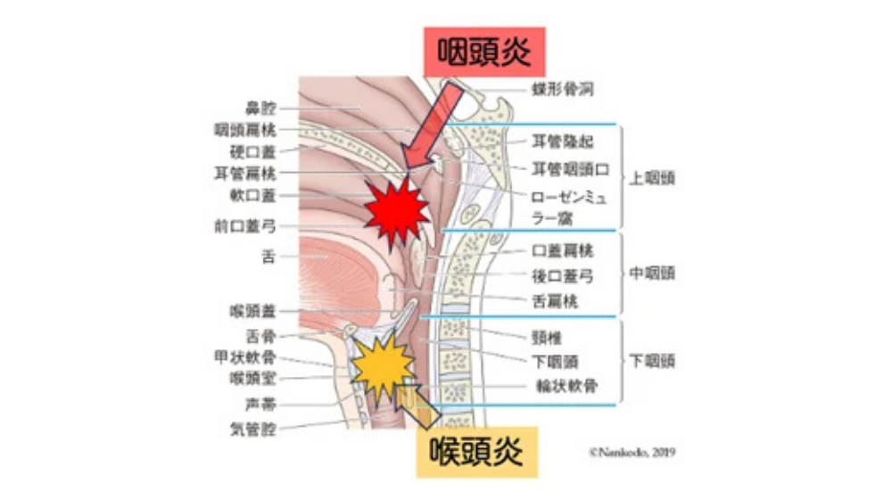 急性扁桃炎の症状や早く治す方法を解説｜急性咽頭炎との違いは？