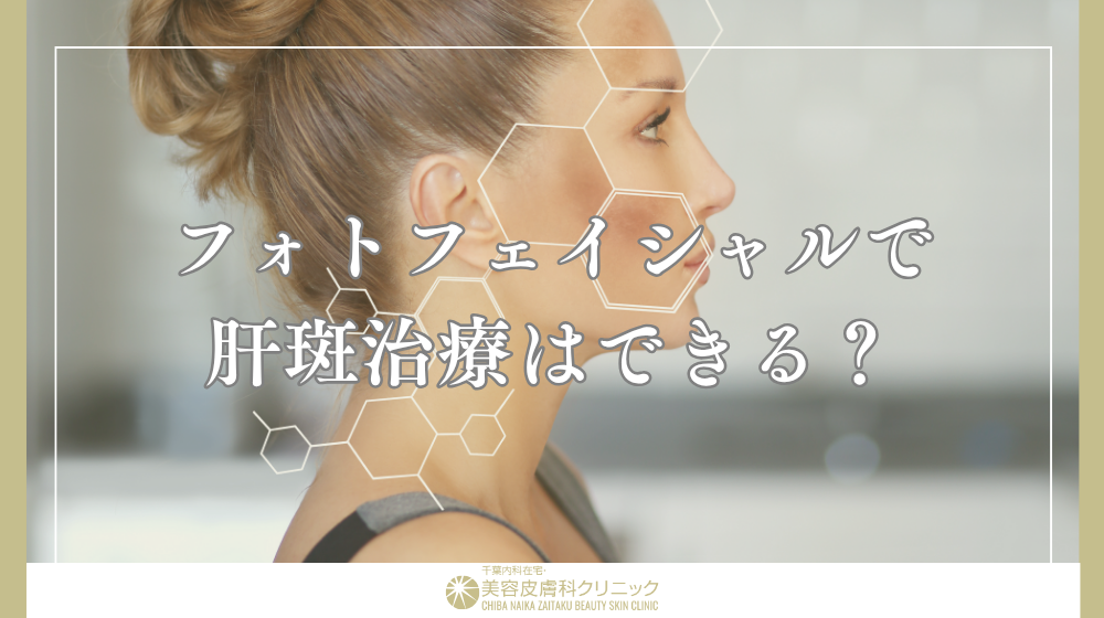 フォトフェイシャルによる肝斑治療|濃くなる原因と失敗しない機械選び