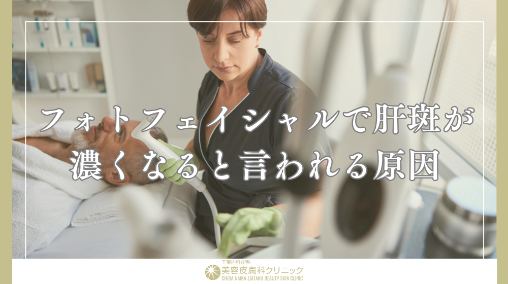 フォトフェイシャルによる肝斑治療|濃くなる原因と失敗しない機械選び