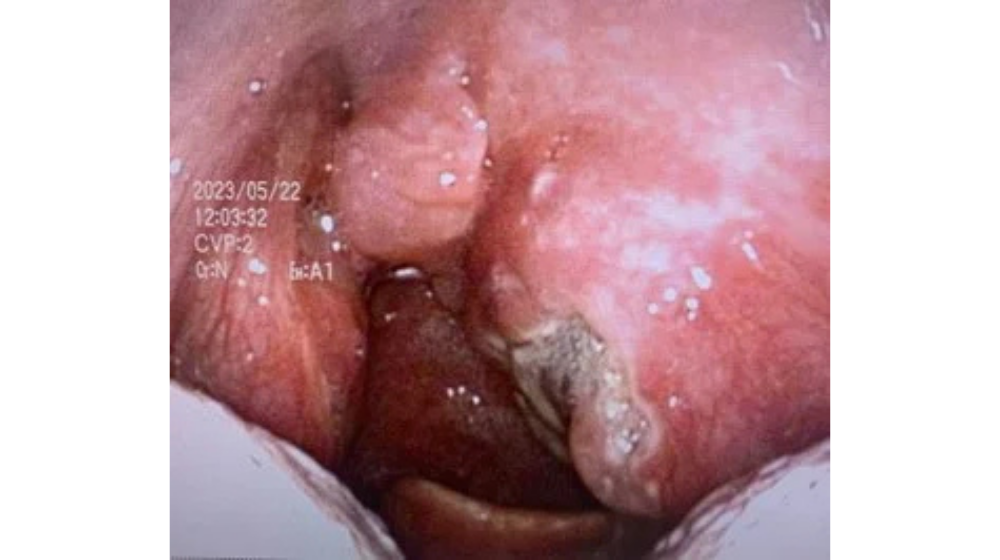 急性扁桃炎の症状や早く治す方法を解説｜急性咽頭炎との違いは？