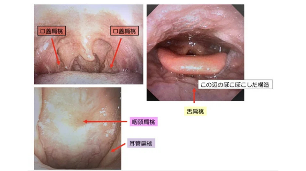 急性扁桃炎の症状や早く治す方法を解説｜急性咽頭炎との違いは？