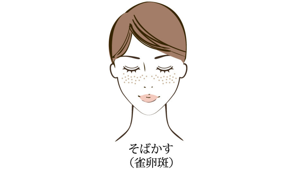 シミが急に増えた原因とは?種類別に見る特徴と改善方法