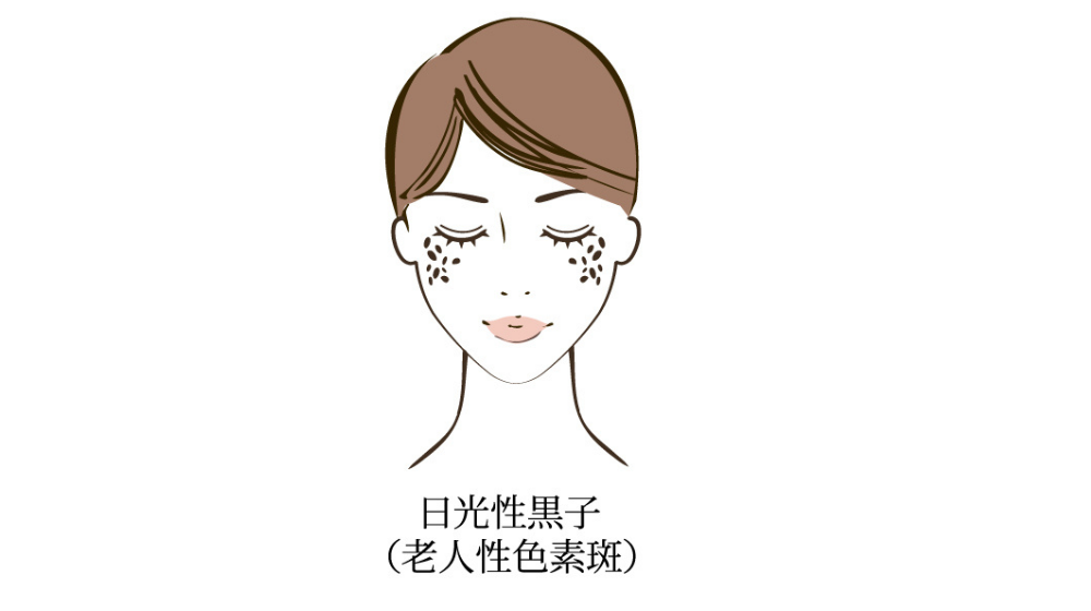 シミが急に増えた原因とは?種類別に見る特徴と改善方法